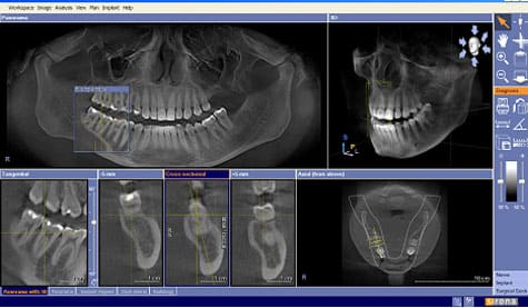 КТ - 3D обследование челюстей