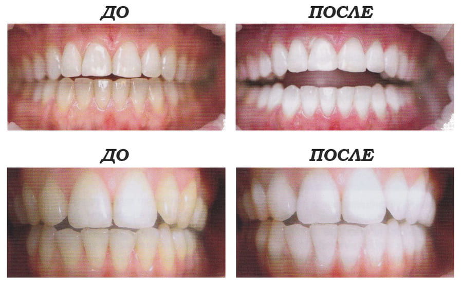 Отбеливание зубов - до и после