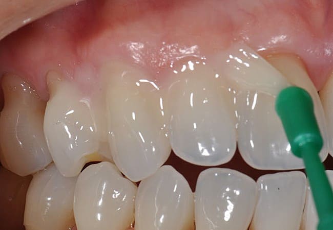 Профессиональная гигиена полости рта - покрытие зубов фтор-лаком