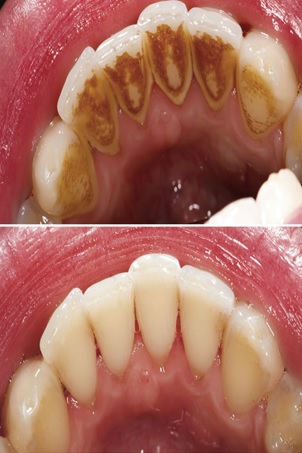 Ультразвуковая чистка зубов (до и после)